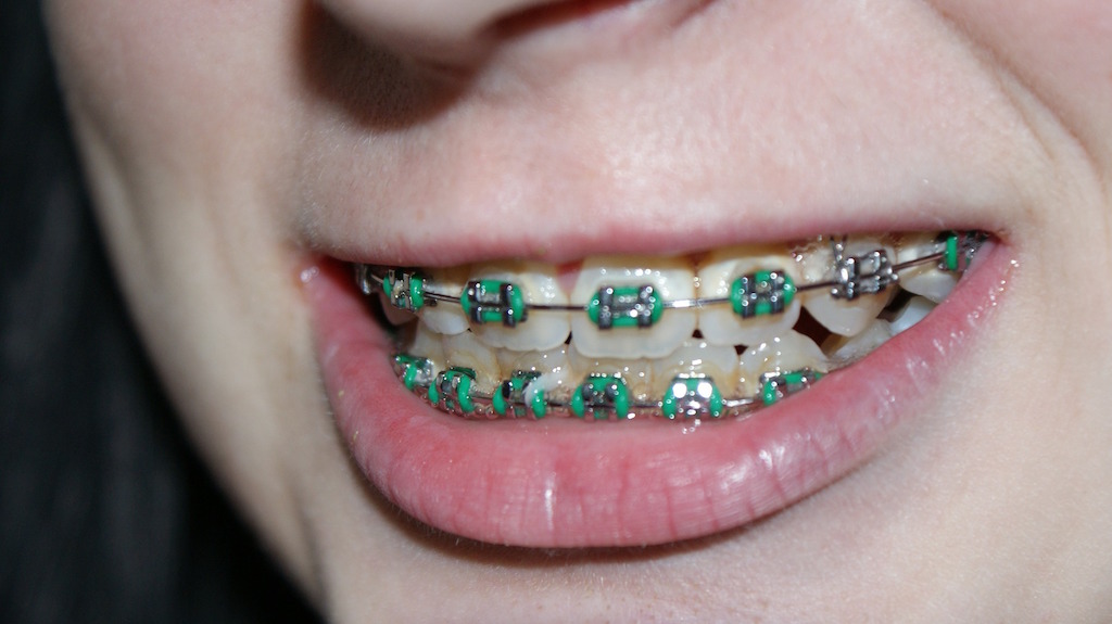 Identifying Pros And Cons Of Braces Treatment by Kami Hoss